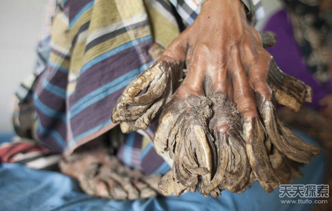 孟加拉国男子患怪病 手脚增生如树根(2)