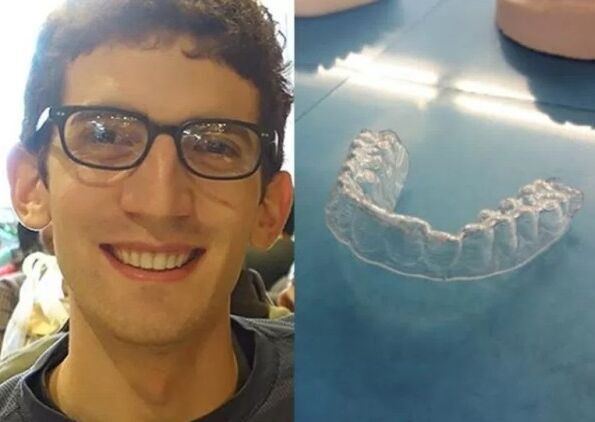 美大学生利用3D技术自制透明牙套 成本60美元_探索者_光明网