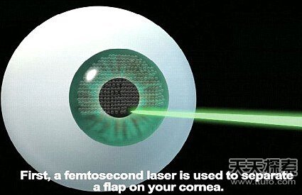 眼科醫(yī)生研發(fā)無痛治療老花眼新療法
