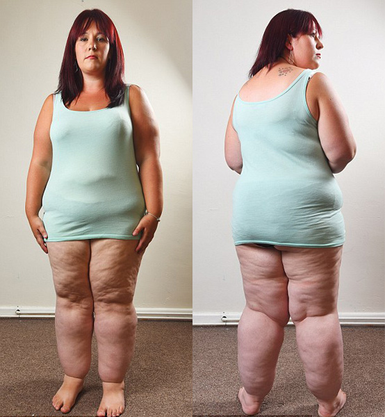 被误诊肥胖英女子实患脂肪综合症 腿粗如大象 _探索者 _光明网