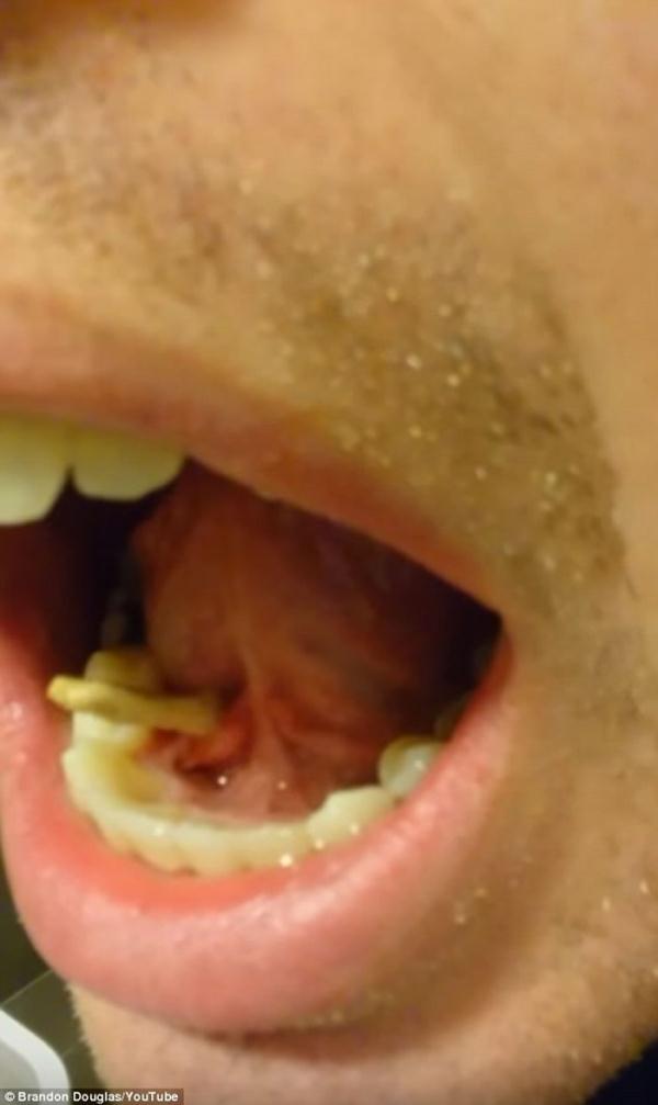 恶心:美国男子拍片分享自行挤出唾液腺结石 犹