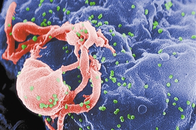 荷兰发现毒力和传染性更强HIV变体