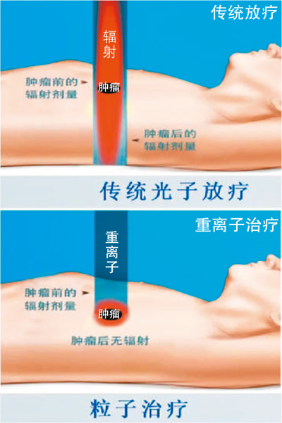 走近重离子治疗